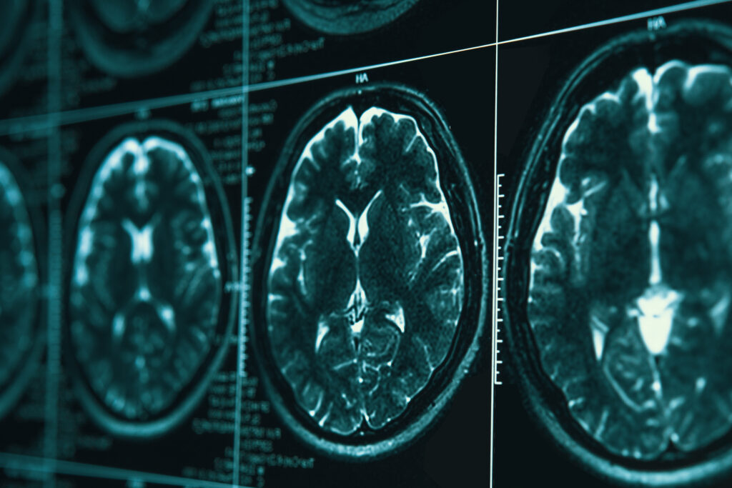 Brain scans illustrating hypofrontality
